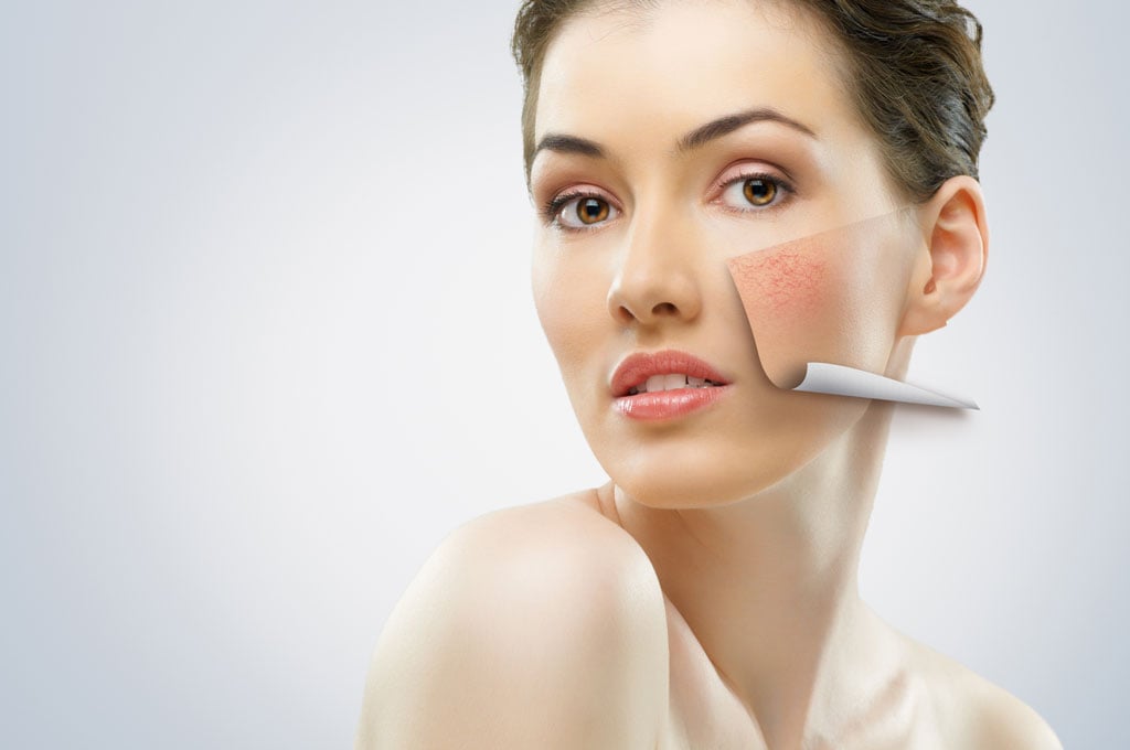 Couperose Rosazea Laserbehandlung Fellbach