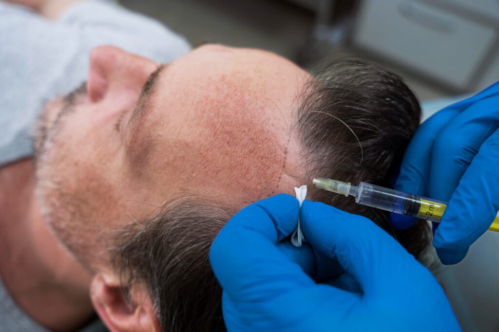Haarausfall Behandlung PRP Radiofrequenz Needling Mesotherapie Fellbach